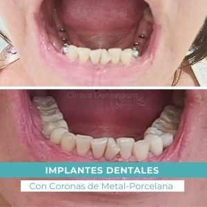 Implantes Dentales
